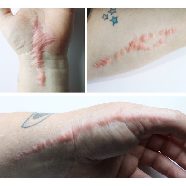 Keloid Scar Set Silicone Prosthetics // Encapsulated Silicone Appliance, Latex Free // Healed Scar Wound Injury // Film and TV SFX MAKEUP