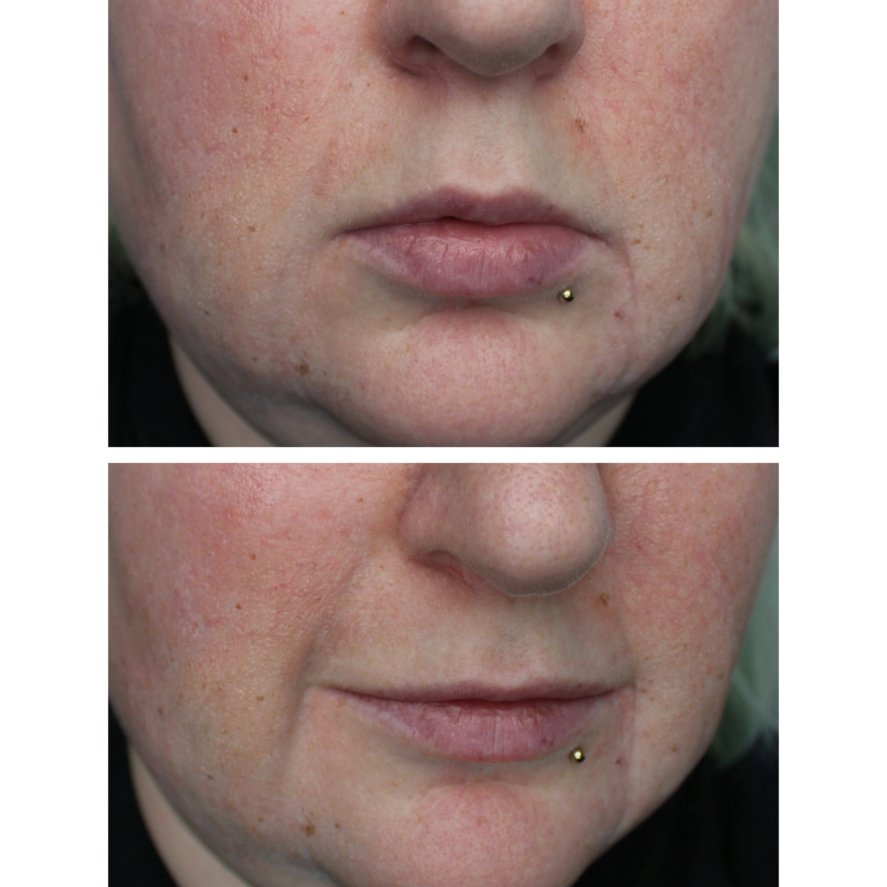 ボディ・フェイスケア used Nasolabial Fold Beauty Nasolabial Folds Anti-Wrinkle Mask Anti-Aging