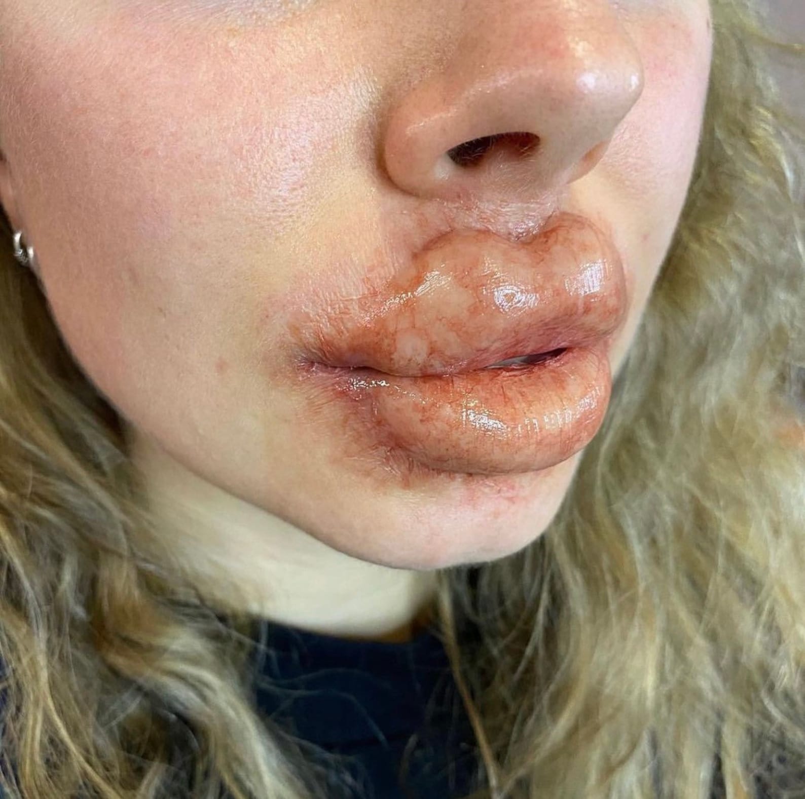 Botched lip filler plastic surgery Halloween makeup