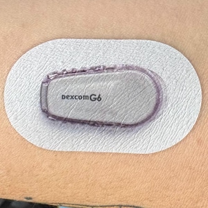 May include: A continuous glucose monitoring system (CGM) sensor, the Dexcom G6, is adhered to the skin. The sensor is a light gray color and is encased in a clear plastic housing. The adhesive patch is white and oval-shaped.