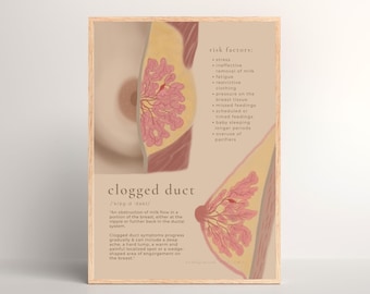 Póster sobre conducto mamario obstruido // anatomía mamaria, consultora de lactancia, póster educativo sobre lactancia materna, DESCARGA DIGITAL