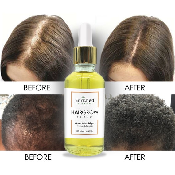 Hair Growth Serum Thinning Hair Hair Treatment Alopecia Etsy