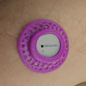 May include: A purple medical device with the text "dexcom" is attached to the skin. The device has a circular design with a central sensor and a decorative, openwork outer ring. The skin around the device is visible.