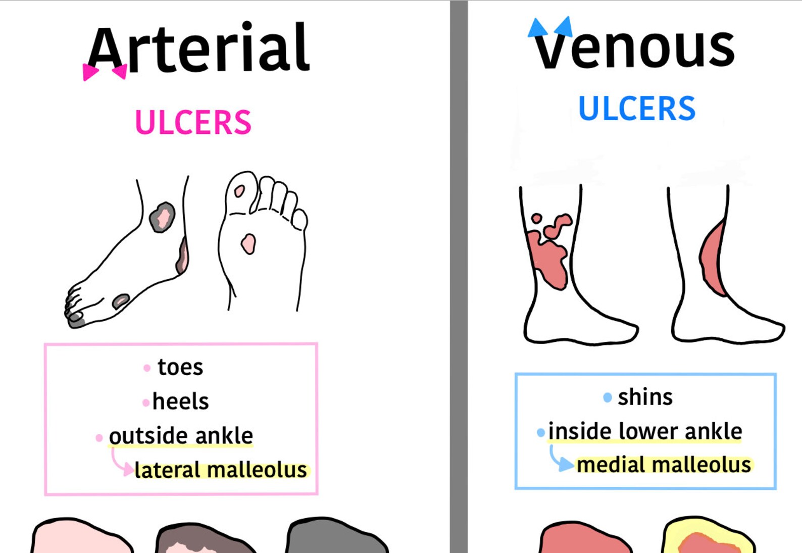Cardiovascular System Arterial And Venous Ulcers Nursing Study Guide Cardiovascular System Arterial And Venous Ulcers Nursing Study Guide