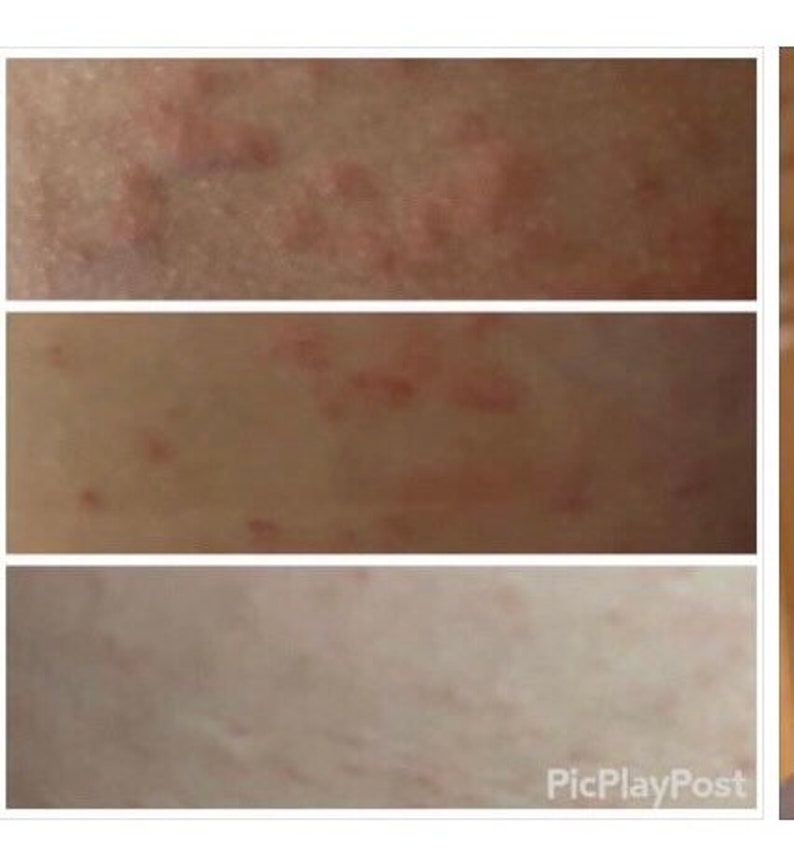 Brown Tail Moth Rash Relief Spray/anti Itch Spray/contact Dermatitis