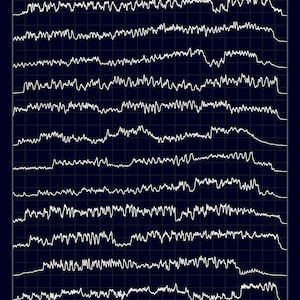 Puede incluir: Una imagen en blanco y negro de un registro de electroencefalograma (EEG). El EEG muestra la actividad cerebral a lo largo del tiempo, con diferentes ondas que representan diferentes estados cerebrales. El EEG es una herramienta común utilizada en medicina para diagnosticar y controlar los trastornos cerebrales.