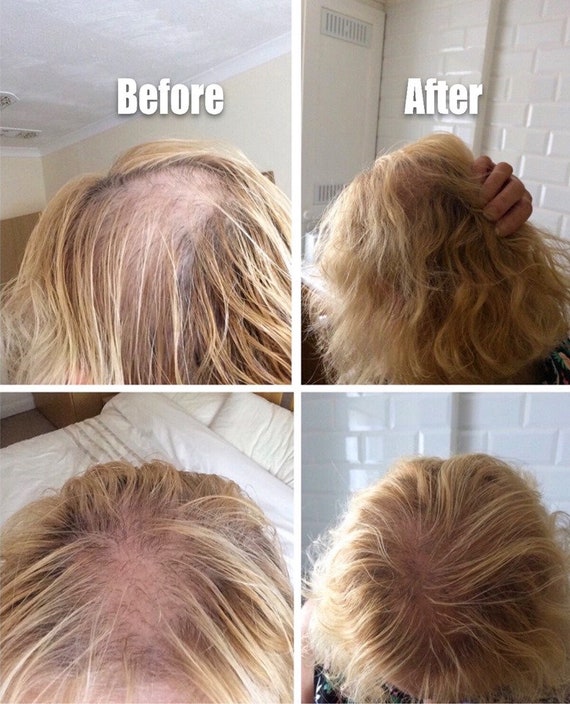 Male / Female Hair Loss Products Natural DHT Blockers Hair - Etsy Male / Female Hair Loss Products Natural DHT Blockers Hair - Etsy