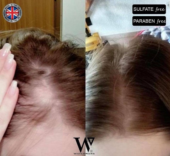 Male / Female Hair Loss Products Natural DHT Blockers Hair - Etsy Male / Female Hair Loss Products Natural DHT Blockers Hair - Etsy