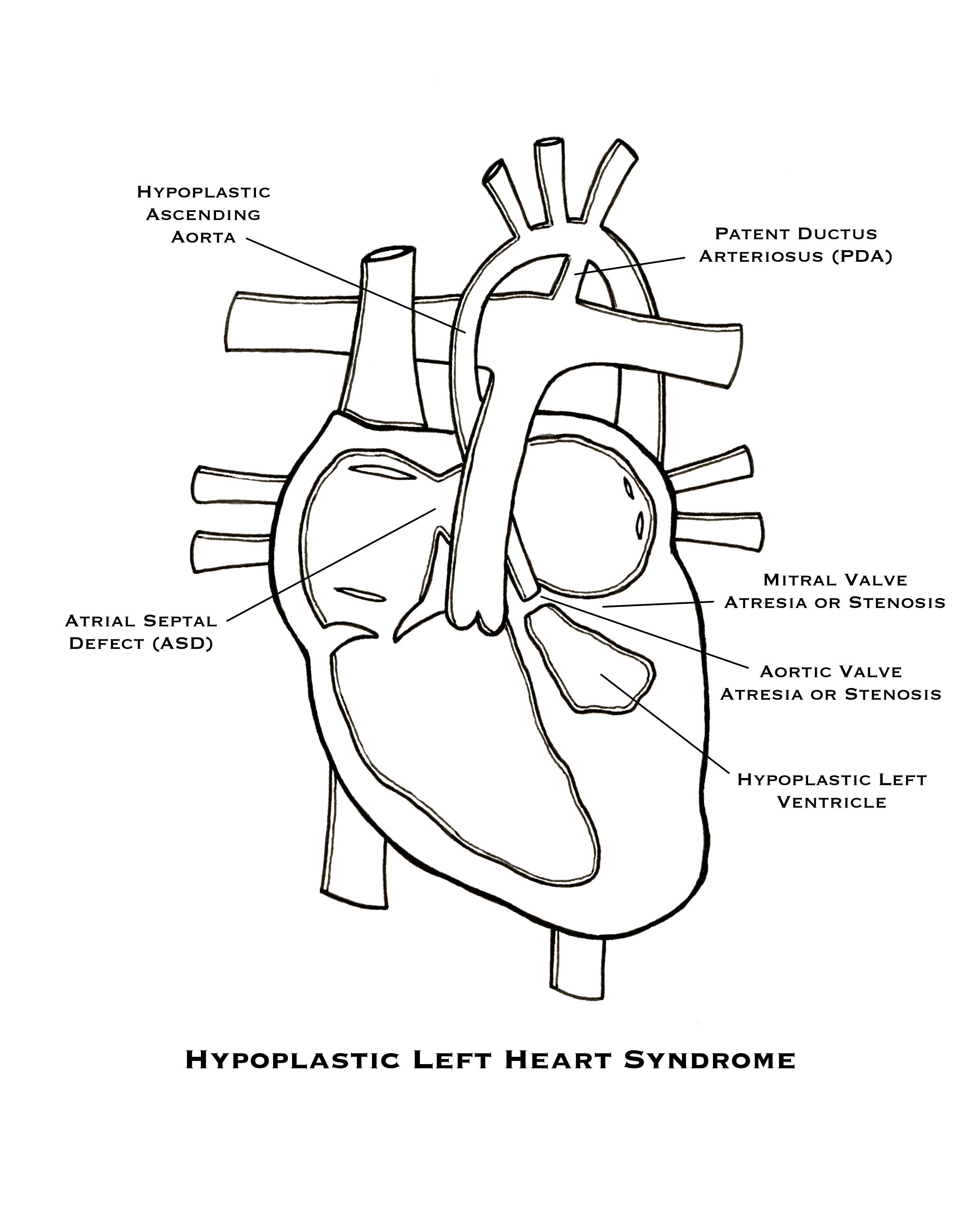 Hypoplastic Left Heart Syndrome - Art Print // Congenital
