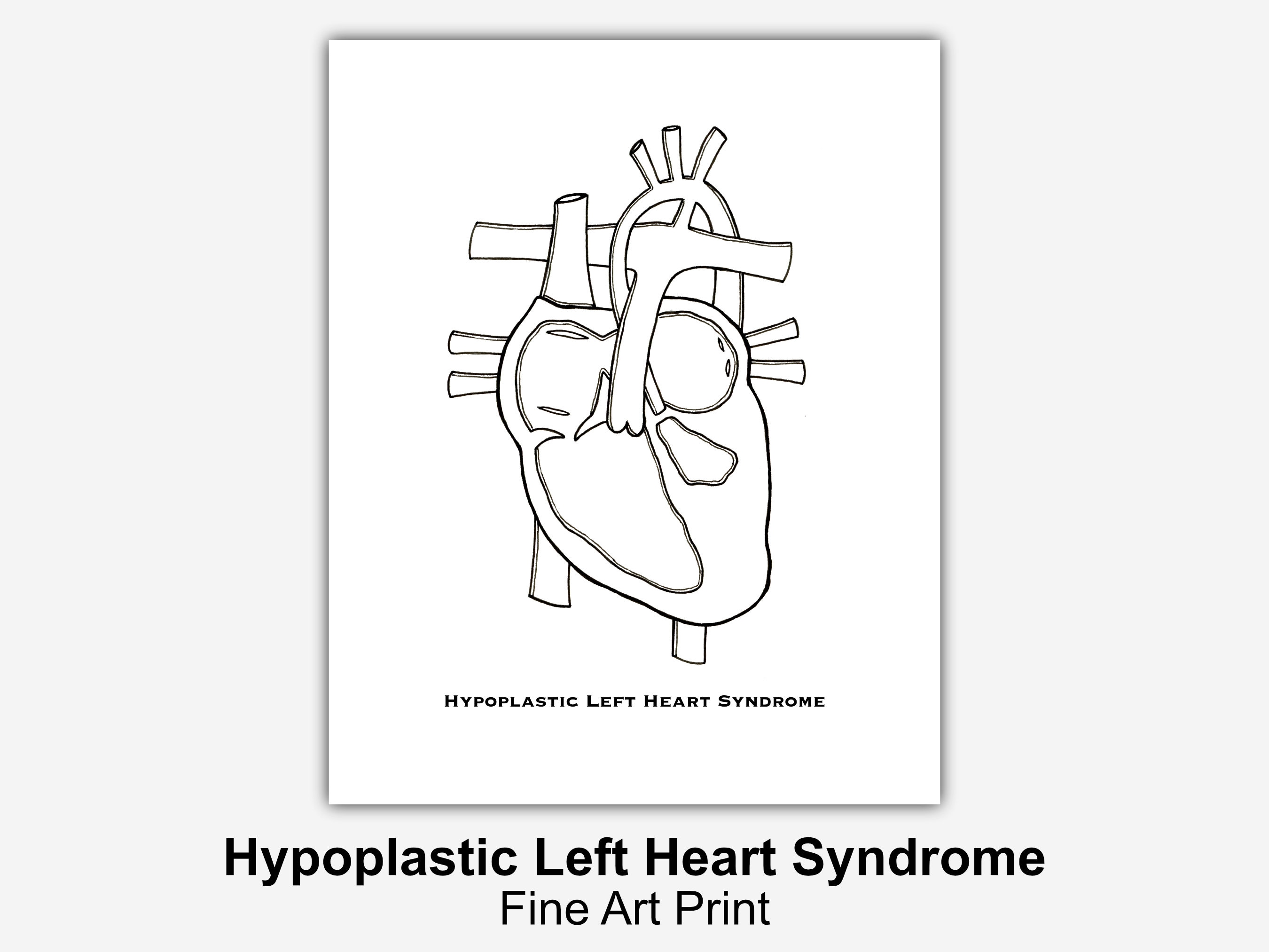 健康・医学 Hypoplastic Left Heart Syndrome Hypoplastic Left Heart Syndrome - Fetal Health Foundation
