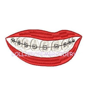 Op de afbeelding: Een rode mond met witte tanden en zwarte beugels. De mond lacht.