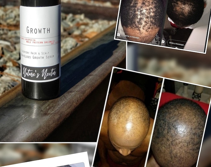 FREE! Marvelous Growth!-Hair growth Serum 1oz Fast Hair Growth DHT Blocker, Fights Female/Male pattern Baldness,Dandruff,Hair Loss,Psoriasis