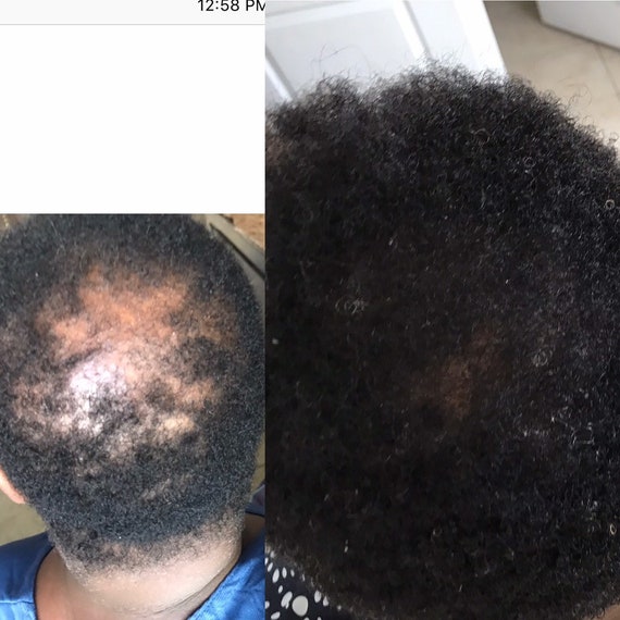 Hair Growth Serum Dry Scalp Serum Natural Hair Regrowth Etsy