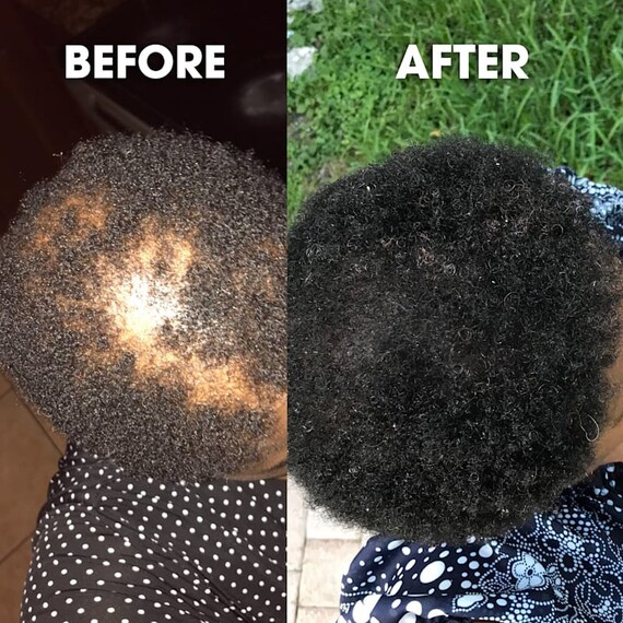 Hair Growth Serum Dry Scalp Serum Natural Hair Regrowth Etsy