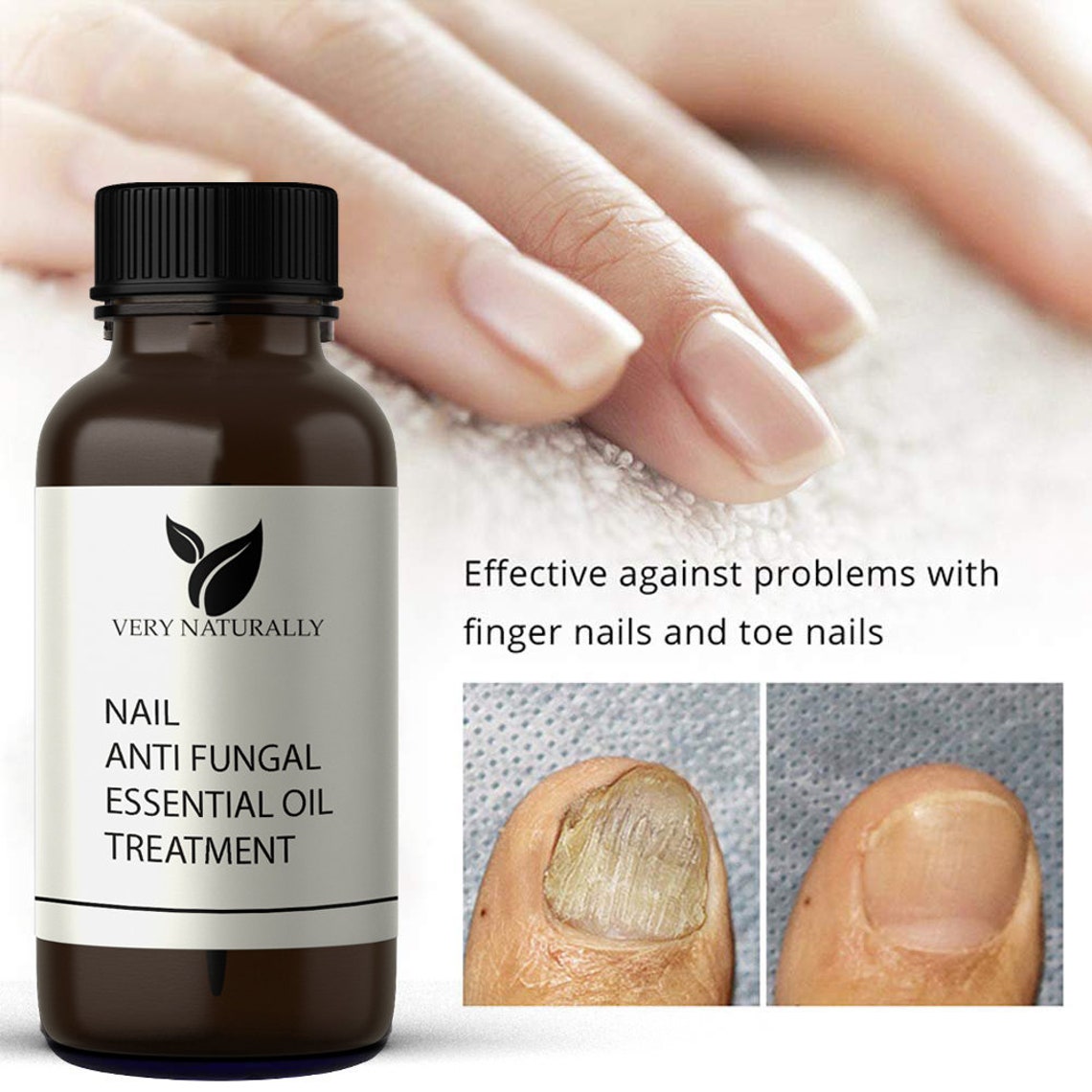 Fungal Nail Treatment Anti Fungus Infections Toe Nails With Etsy UK