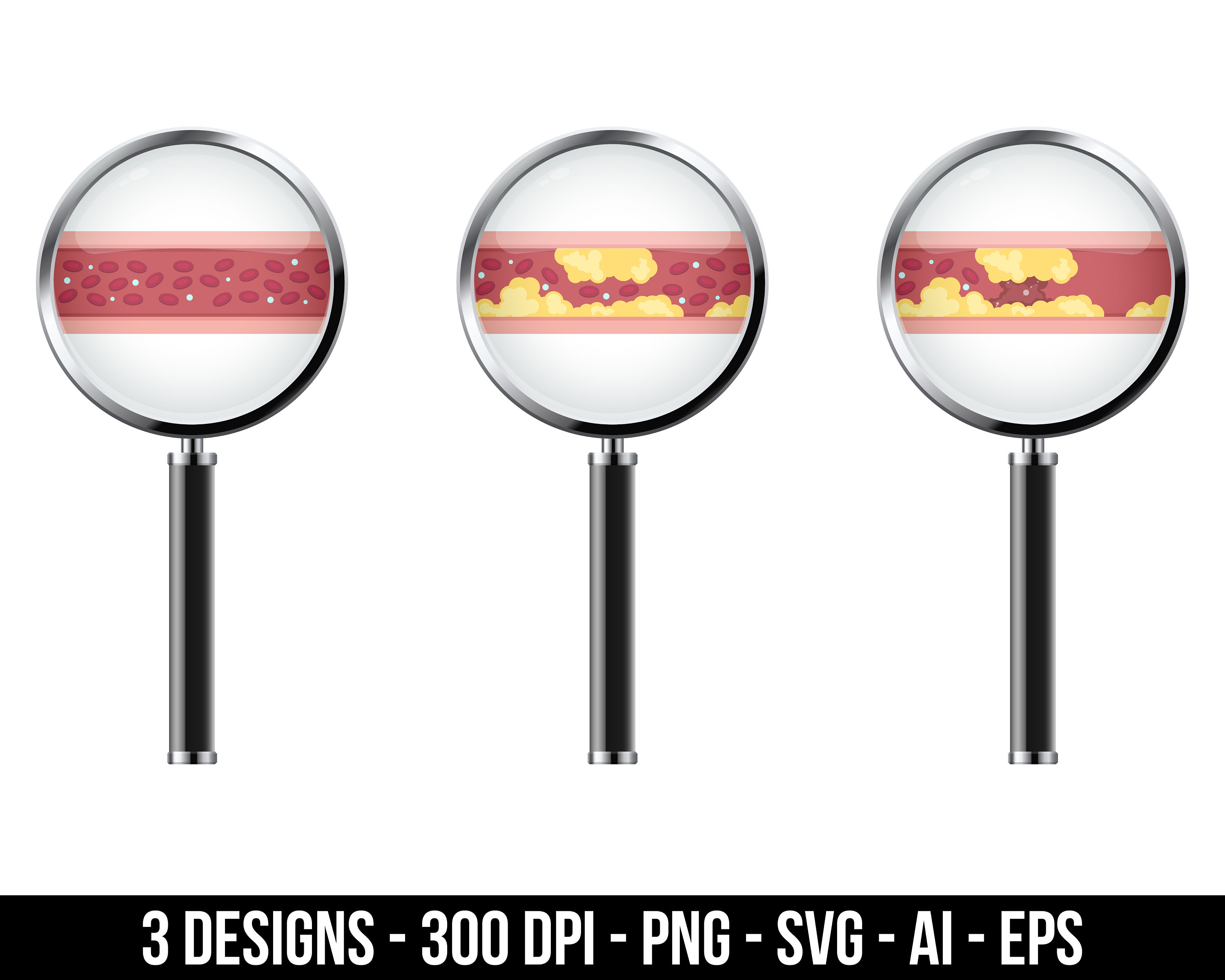 Blood Vessels With Atherosclerosis Clipart Set. Digital Images or ...