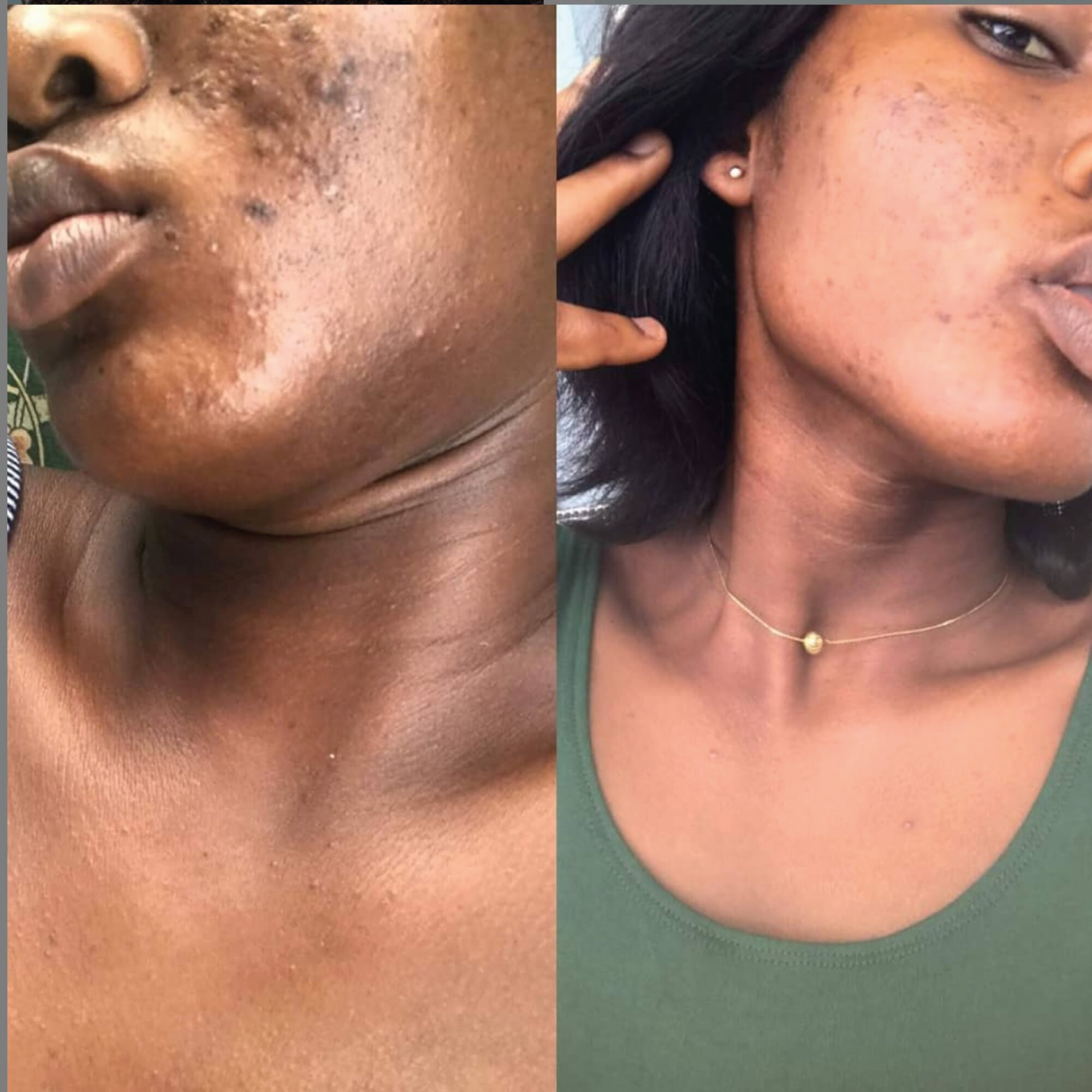 CYSTIC ACNE TREATMENT acne removal face oil acne scars Etsy