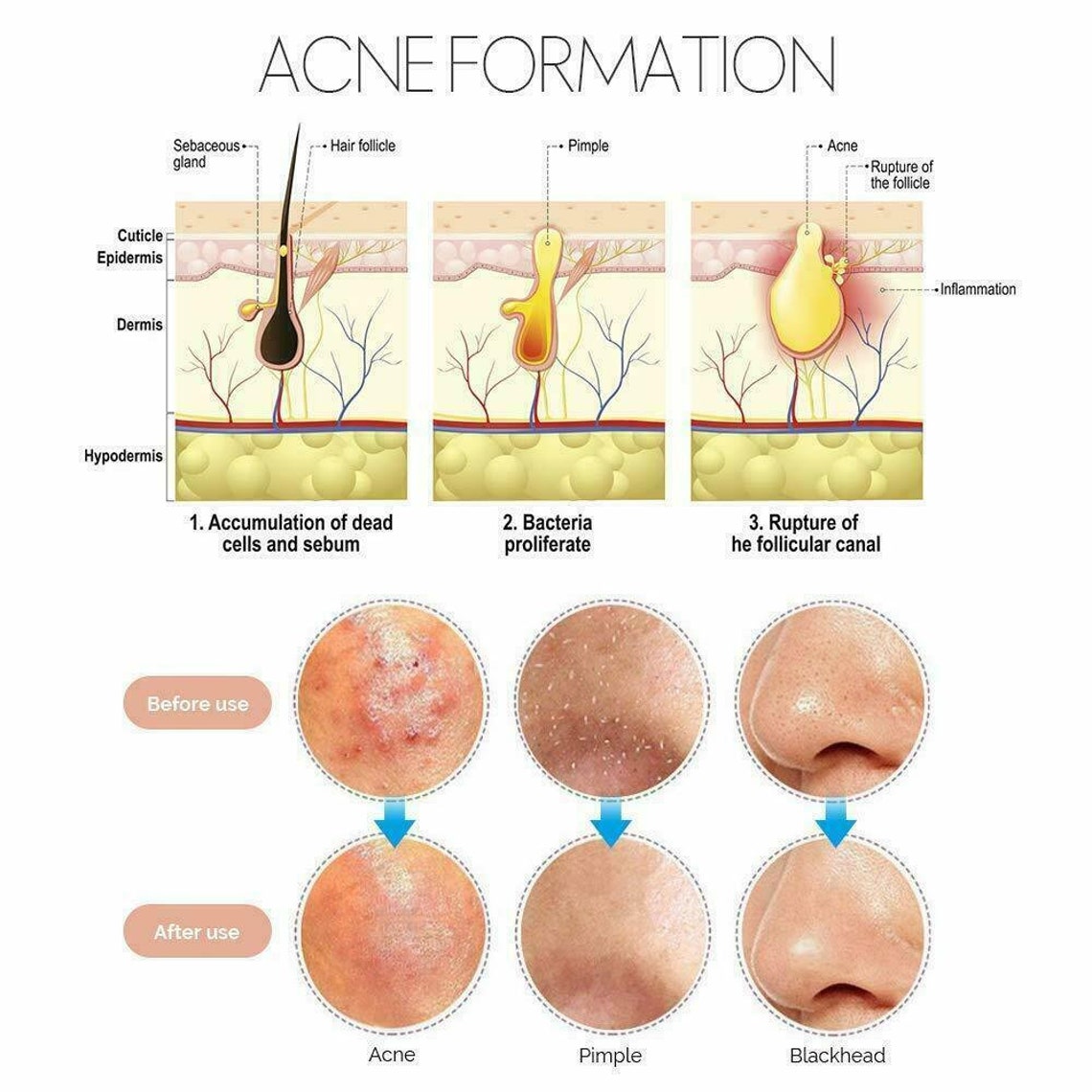 Blackhead Whitehead Acne Pimple Spot Comedone Extractor Etsy