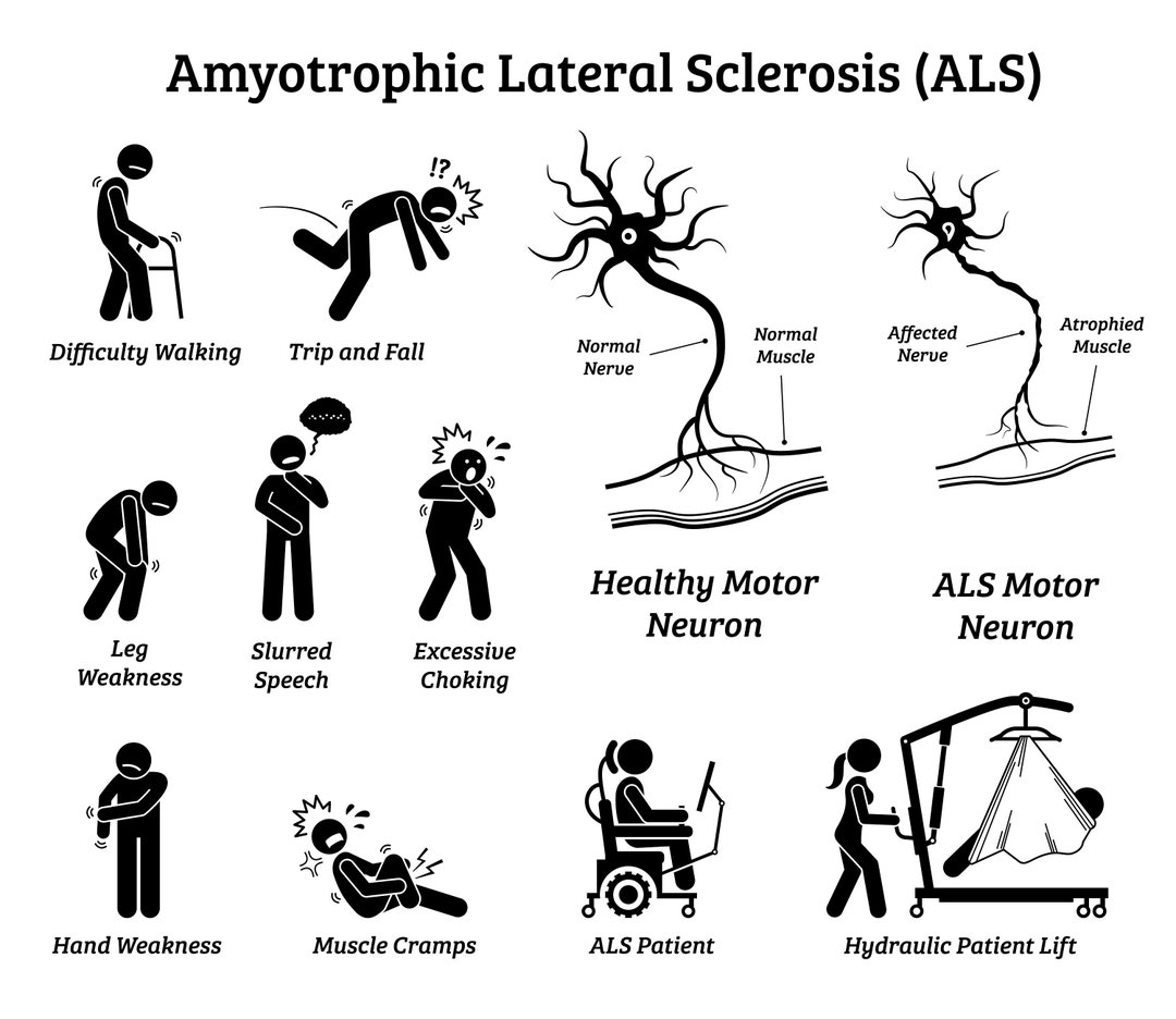 Amyotrophic Lateral Sclerosis ALS Disease Signs Symptoms Sickness Illness Medical Condition