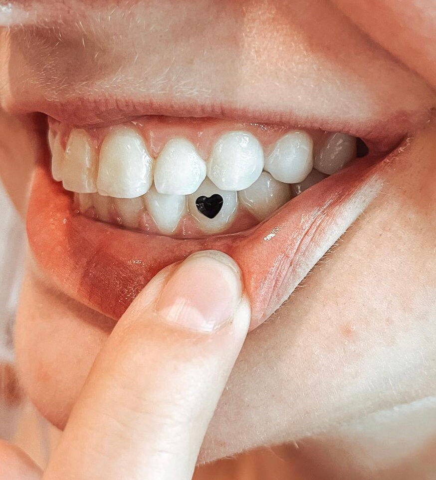 Tooth Gems in Surrey, Tooth Charms