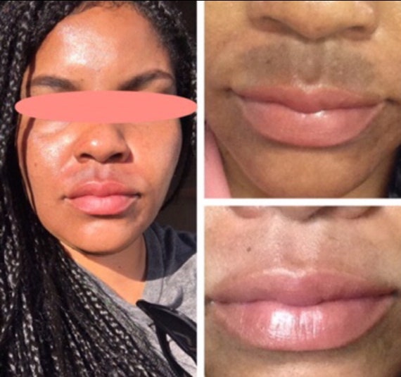 facial discoloration