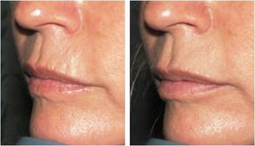 Fine Line Filler Anti Wrinkle Silicone Lip & Eye Pad Face - Etsy