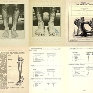 May include: A black and white anatomical illustration of the human foot and leg bones. The illustration shows the femur, patella, fibula, tibia, tarsals, metatarsals, and phalanges.