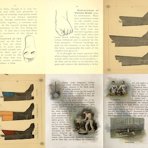 May include: An illustration of a foot with a bunion, a common foot deformity. The illustration shows the foot from the side, with the bunion on the big toe. The text below the illustration explains that bunions are often caused by wearing improperly fitted shoes.