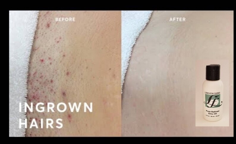 Ingrown hair bikini area emu oil Etsy