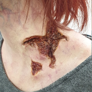 May include: A close-up of a person's neck with a large, open wound that appears to be healing. The wound is red, brown, and slightly raised. The person has red hair.