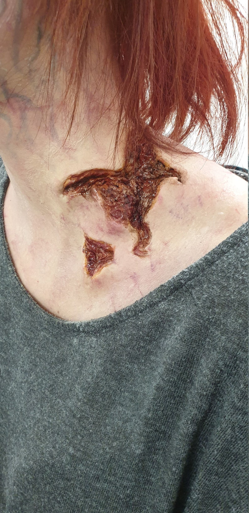 May include: A close-up of a person's neck with a large, open wound that appears to be healing. The wound is red, brown, and slightly raised. The person has red hair.