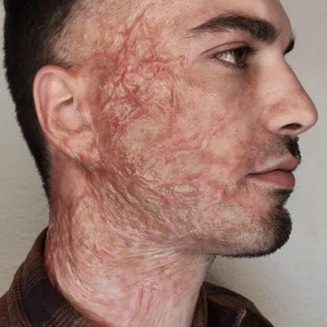 K&ouml;nnte beinhalten: Nahaufnahme eines Gesichts und Halses im Profil mit einer gro&szlig;en, erhabenen, roten und wei&szlig;en Narbe, die die rechte Seite des Gesichts und Halses bedeckt.