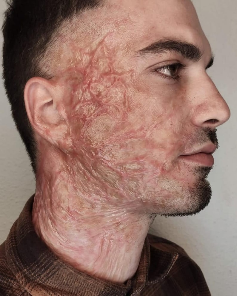 K&ouml;nnte beinhalten: Nahaufnahme eines Gesichts und Halses im Profil mit einer gro&szlig;en, erhabenen, roten und wei&szlig;en Narbe, die die rechte Seite des Gesichts und Halses bedeckt.