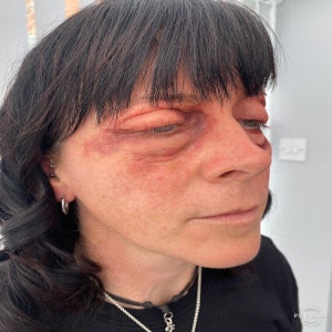 Puede incluir: Primer plano de la cara de una persona que muestra un ojo rojo e hinchado con un moret&oacute;n debajo. La persona tiene el pelo oscuro y lleva una camisa negra.