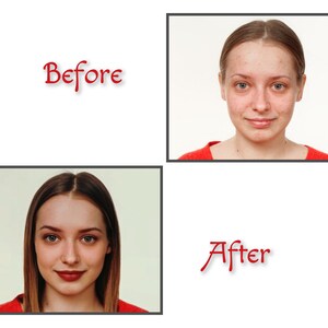 Op de afbeelding: Voor- en nafoto's van een gezicht. De foto van ervoor toont de persoon met acne en puistjes. De foto van daarna toont de persoon met een heldere huid.