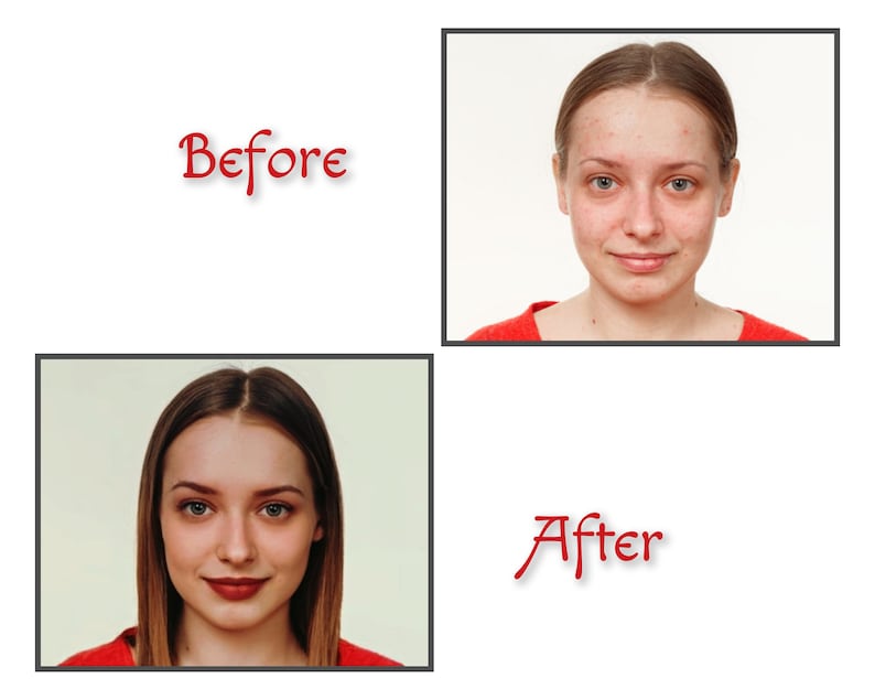 Op de afbeelding: Voor- en nafoto's van een gezicht. De foto van ervoor toont de persoon met acne en puistjes. De foto van daarna toont de persoon met een heldere huid.