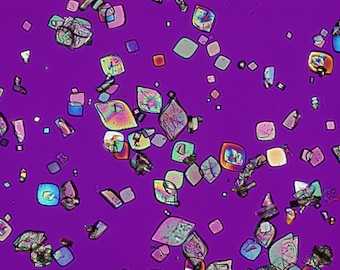 Uric Acid Crystals, Red Compensator