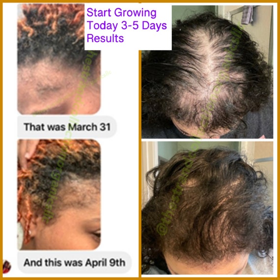 THE BEST Hair Oil for Hair Growth to Grow Hair for Men - Etsy THE BEST Hair Oil for Hair Growth to Grow Hair for Men - Etsy