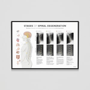 May include: A diagram illustrating the stages of spinal degeneration. The diagram shows a human figure with a spine, and four x-ray images of a spine in different stages of degeneration. The stages are labeled "Normal", "Stage I", "Stage II", and "Stage III". The text "Receiving chiropractic care in time is key to prevent, reverse or stop spinal degeneration." is at the top of the diagram.