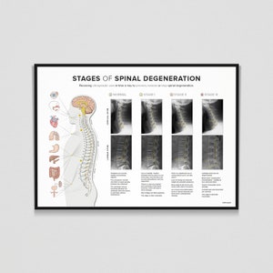 Spinal Degeneration - X-RAY -  Cervical & Lumbar