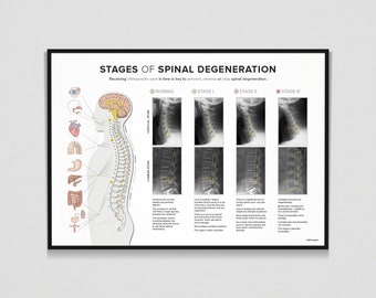 Spinal Degeneration - X-RAY -  Cervical & Lumbar