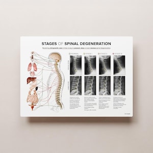May include: A medical illustration depicting the stages of spinal degeneration. The illustration shows a human body with the spinal cord and nerves highlighted. The illustration also shows x-ray images of the spine at different stages of degeneration. The text "Stages of Spinal Degeneration" is at the top of the illustration.