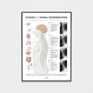 Spinal Degeneration - X-RAY