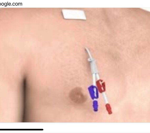 Image Hickman Process Hickman Catheter