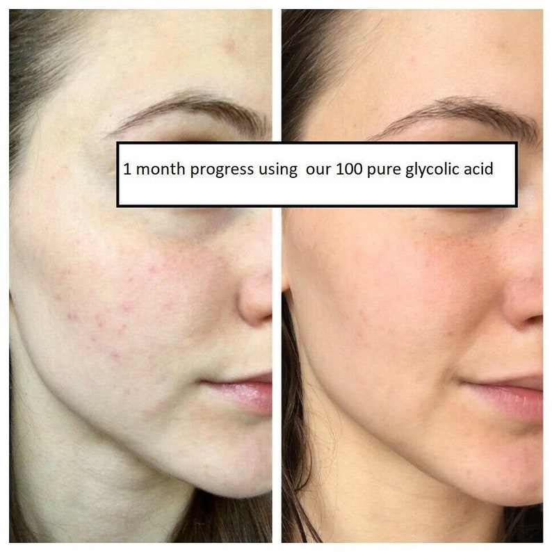 Glycolic Acid PeelHerbal Calm Acne Scar Tattoo 7 days no Etsy