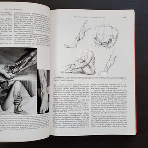 May include: A black and white illustration of a surgical procedure. The illustration shows a person sitting with their leg extended. The leg has a large incision on the lower leg. The illustration is labeled with the letters A, B, C, and D. The caption below the illustration reads "Typical steps in the preparation and transfer of an open jump flap to the lower leg. (From Cannon, B.: The use of open jump flaps in lower extremity repairs. Plast. Reconstr. Surg., 2:136, 1947. Copyright &copy; 1947, The Williams & Wilkins Company, Baltimore)"