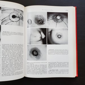 May include: A medical textbook page with black and white images of a breast reconstruction procedure. The images show different stages of the procedure, including the removal of the nipple, the creation of a new nipple, and the final result. The text on the page describes the procedure in detail.