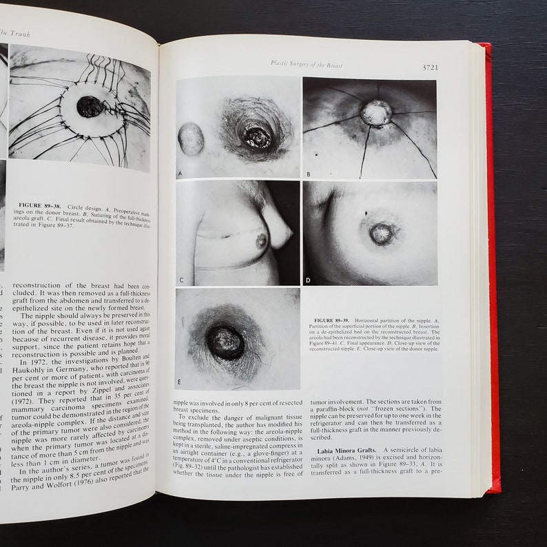 May include: A medical textbook page with black and white images of a breast reconstruction procedure. The images show different stages of the procedure, including the removal of the nipple, the creation of a new nipple, and the final result. The text on the page describes the procedure in detail.