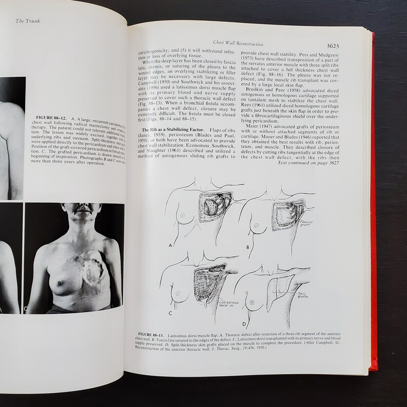 May include: A medical illustration showing different methods for repairing a chest wall defect. The illustration shows a chest wall defect after resection of three ribs, a latissimus dorsi muscle flap, and a skin graft.