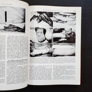 May include: A black and white medical textbook page with images of a lower leg with skin grafts. The text on the page discusses the use of microvascular free flaps in reconstructive surgery of the lower extremity.